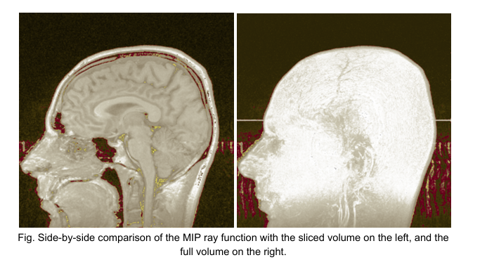 mri-head-mip